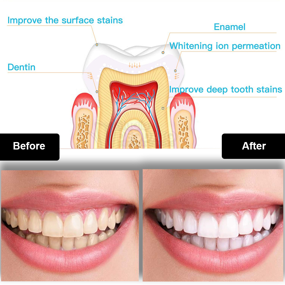 Dental Teeth Whitening Kit Min - Whitening Pen Bleach recensie en prijs