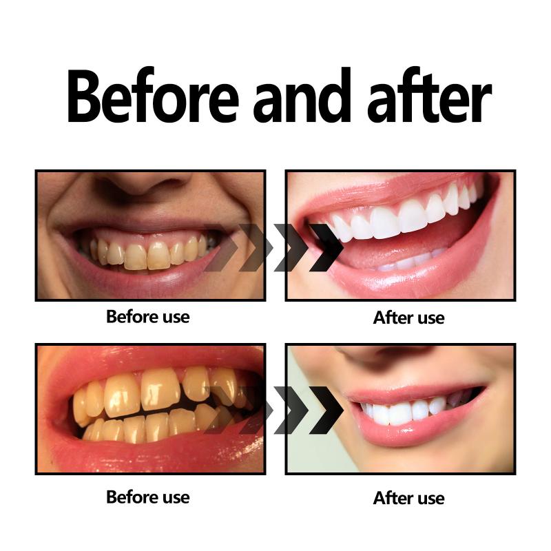 Teeth Whitening Powder Charcoa - Teeth Whitening With Baking Soda recensie en prijs