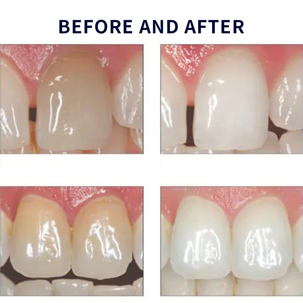 Opalescence Whitening 20% PF 2 - Teeth Whitening Opalescence recensie en prijs