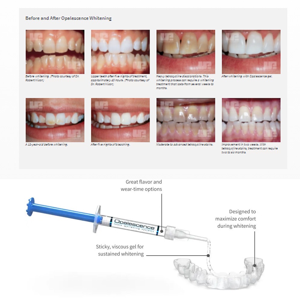 Opalescence Whitening 20% PF 2 - Teeth Whitening Opalescence recensie en prijs