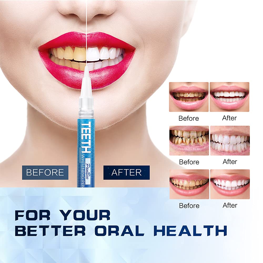Teeth Whitening Pen Remove Cof - Teeth Whitening Opalescence recensie en prijs