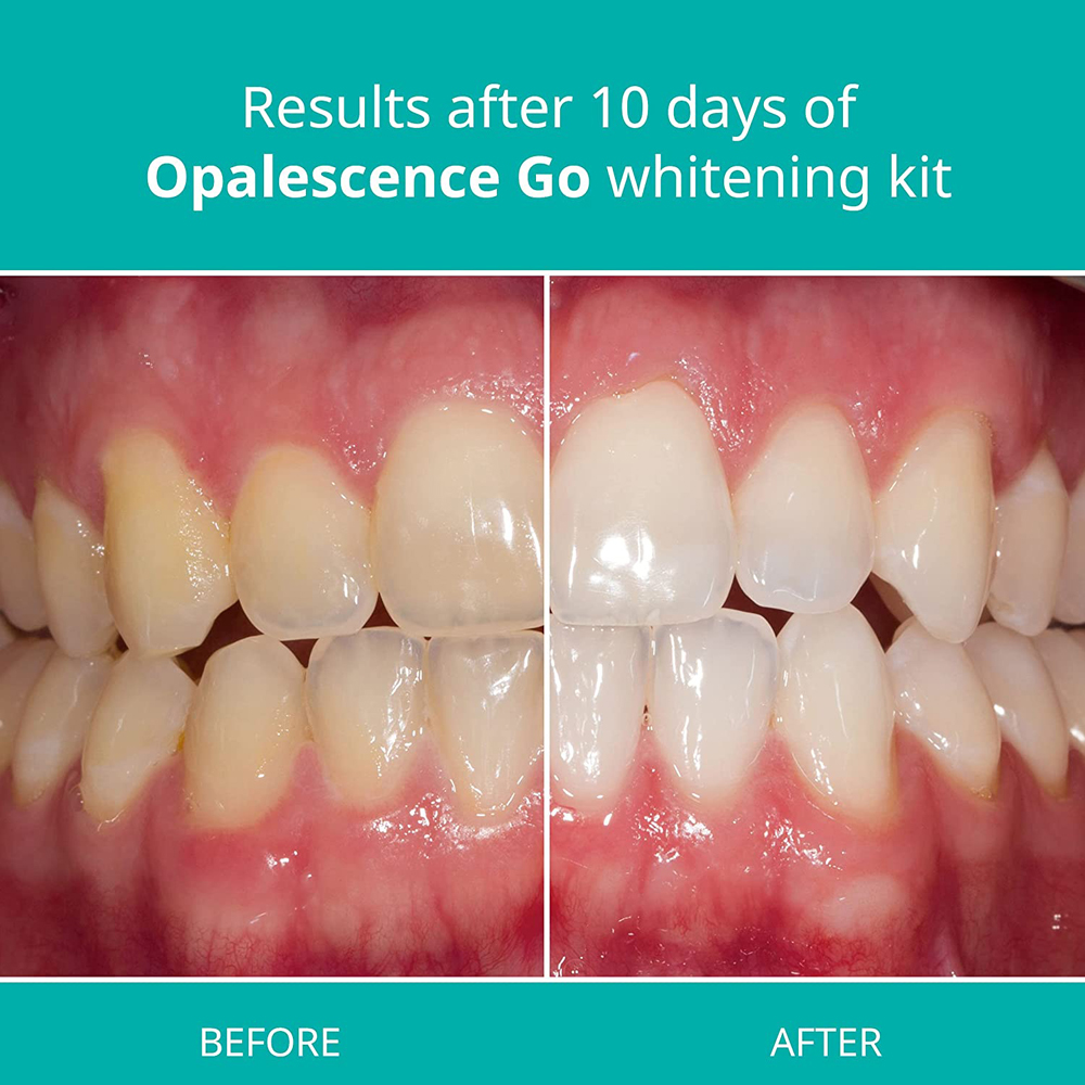 Opalescence Go Teeth Whitening - Teeth Whitening Opalescence recensie en prijs