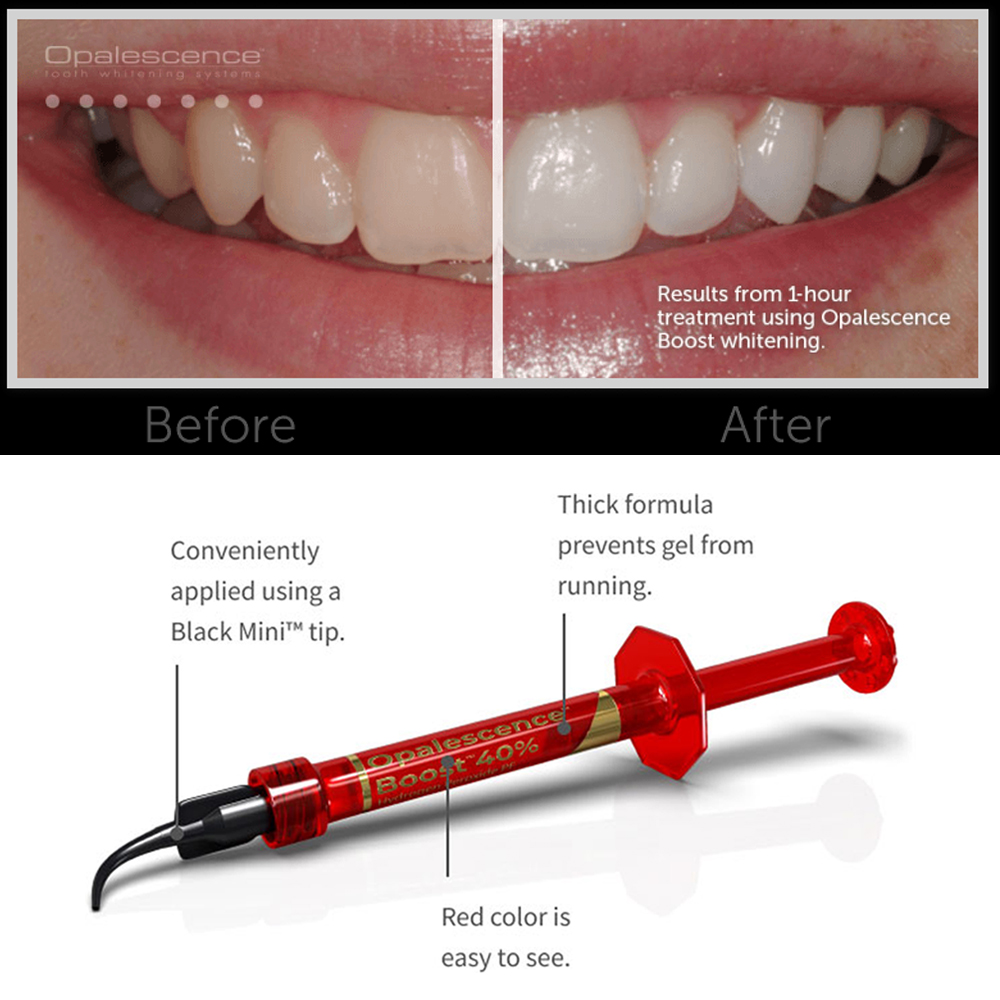 Ultradent Opalescence Boost PF - Teeth Whitening Opalescence recensie en prijs