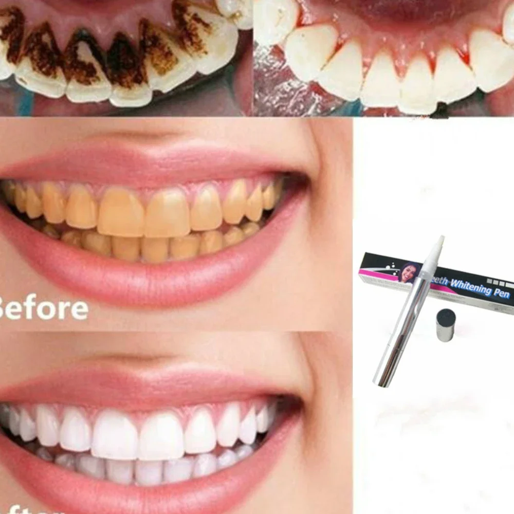 Hot Sale Teeth Whitening Gel P - Whitening Pen Bleach recensie en prijs